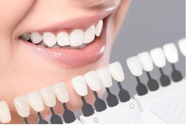 Dental Veneers’ Importance In Dentistry